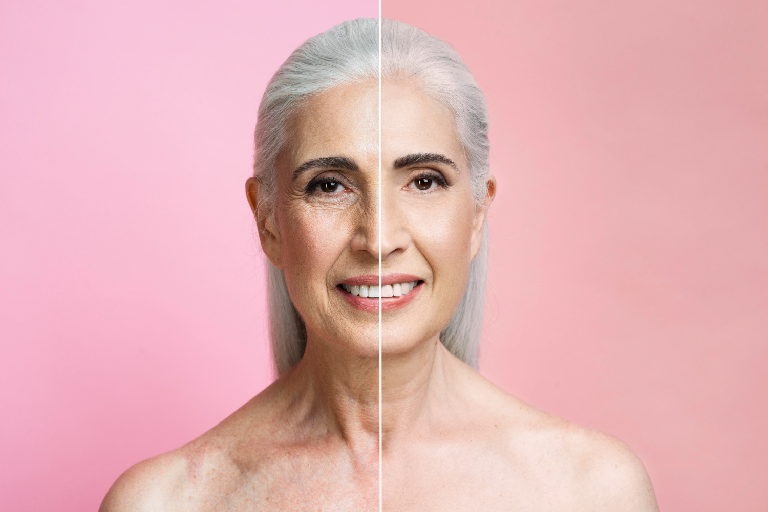 Redensificación con ácido hialurónico - CLS Medicina Estética