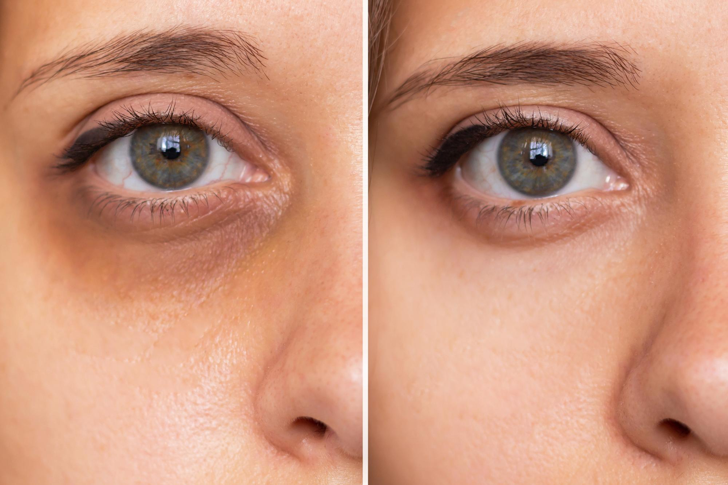 Tratamiento de ojeras - CLS Medicina Estética