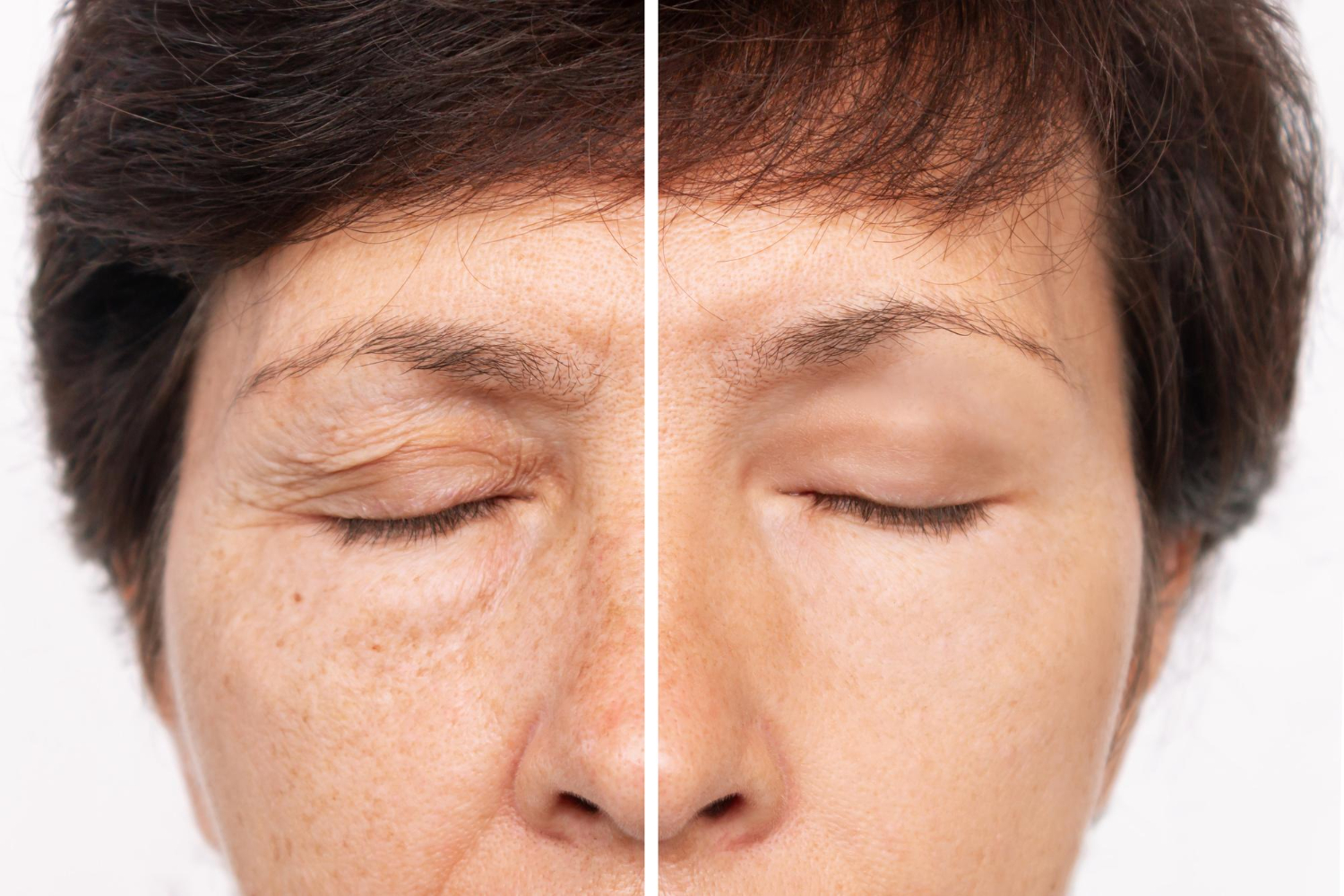 Rejuvenecimiento facial - CLS Medicina Estética